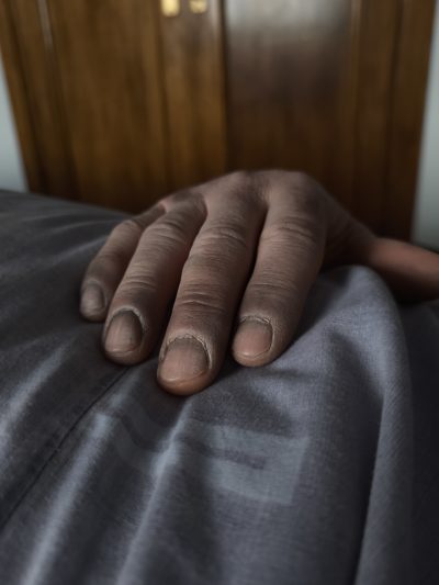 Fenómenos cadavéricos FX: detalle de textura de piel con hundimiento de tejido