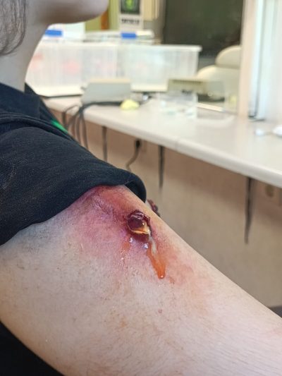 Herida infectada FX: simulación de herida con exudado y enrojecimiento